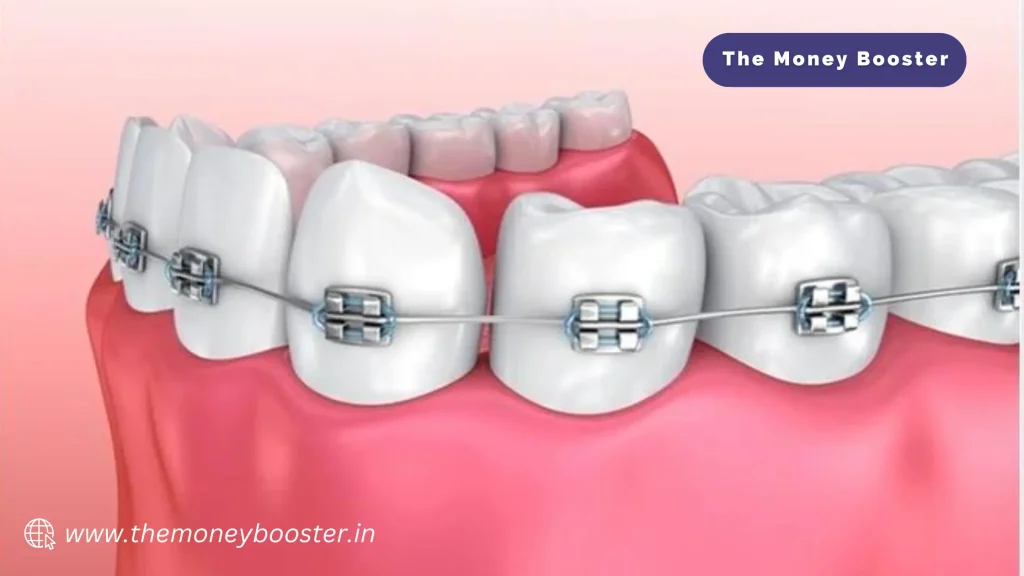 Human Teeth With Wearing Braces Example Of What Happens if You Lose Insurance During Braces